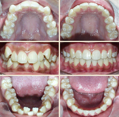 Patient #3: Severe Crowding, Blocked-out Upper Canines ... Perfect Smile!