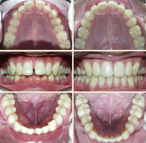 Patient #5: Severe Overjet & Protrusion, Upper & Lower Midline Gaps ... Perfect Smile!