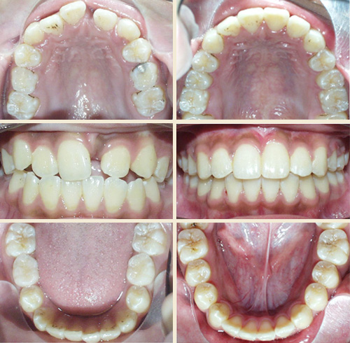 Patient #8: Impacted Upper Central Incisor, Narrow Upper Jaw, Crowding ... Perfect Smile!