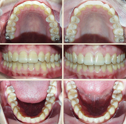 Patient #9: Invisalign - Upper & Lower, Total Treatment Time = 5 months ... Perfect Smile!