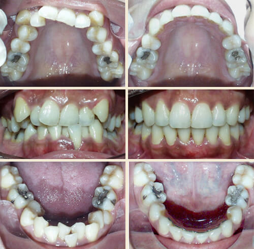 Patient #1: Severe Upper & Lower Crowding, Front Crossbite ... Perfect Smile!