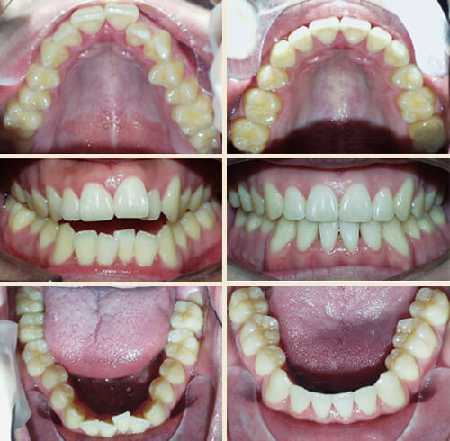 Patient #10: Front Open-Bite, Narrow Upper Jaw, Double-Jaw Surgery Required ... Perfect Smile!