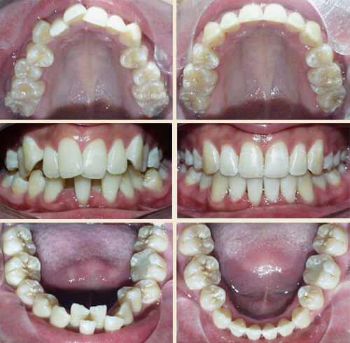 Patient #2: Crowding, Protrusive Upper Front Teeth ... Perfect Smile!
