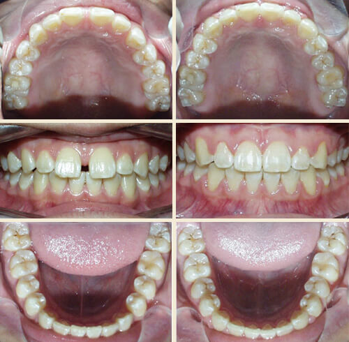 Patient #4: Large Upper Midline Gap, Lower Spacing ... Perfect Smile!
