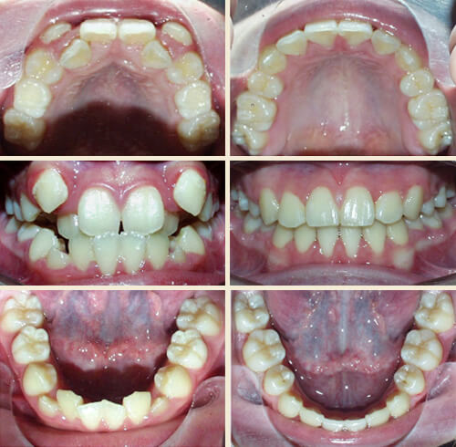 Patient #6: Severe Crowding, “Vampire-Like” Canines, Underbite ... Perfect Smile!