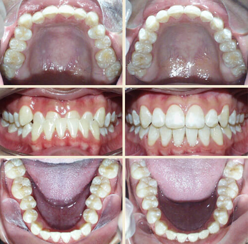 Patient #7: Underbite, Front Crossbite, No Jaw Surgery Required ... Perfect Smile!